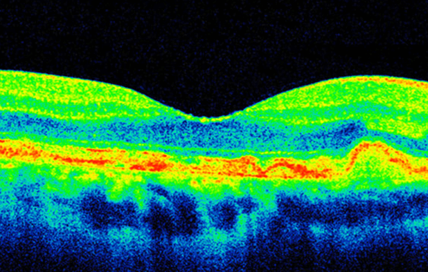 Age-related macular degeneration - Coastal Eye Surgeons