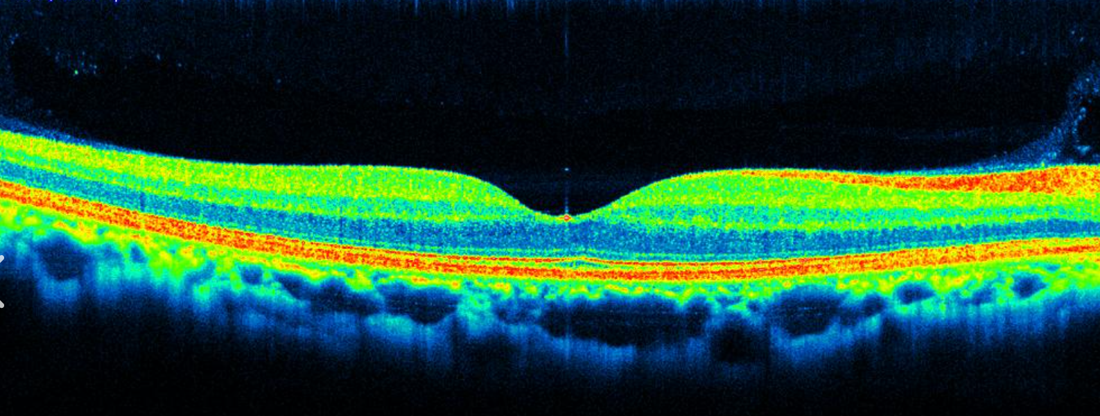 Age-related macular degeneration