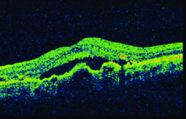 Age-related macular degeneration - Coastal Eye Surgeons